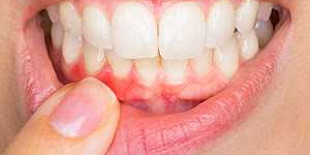 New Alternative to Gum Disease Treatment