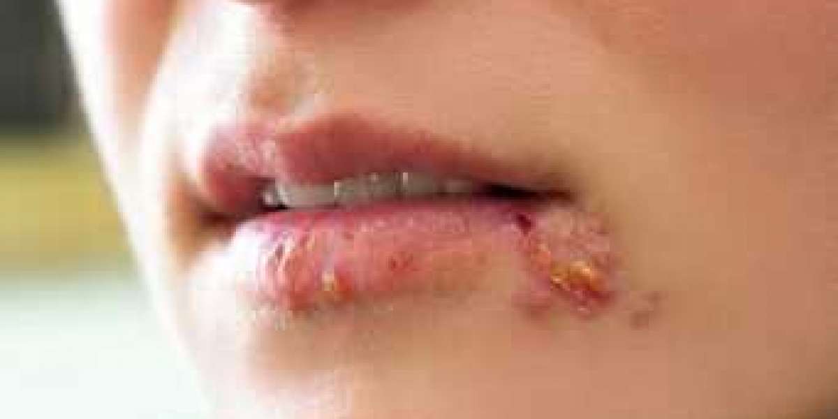 Can You Battle Herpes Infections? Yes, You Can!
