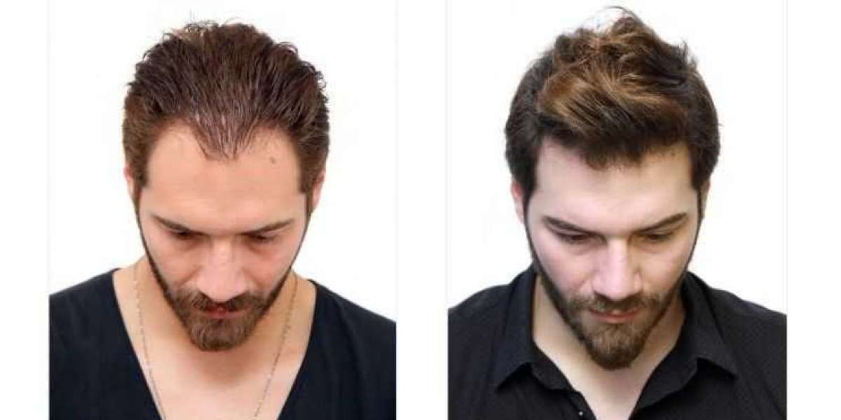 How Much Do Hair Transplants Cost