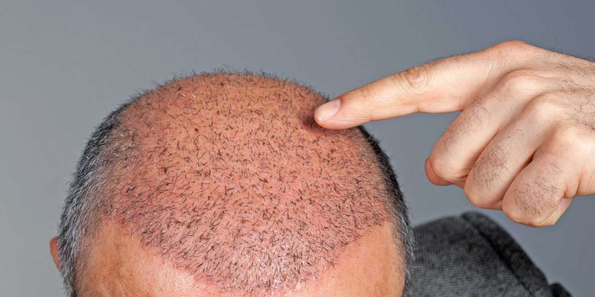 HAIR TRANSPLANT FOR WOMEN - UNCOMMON FACTS YOU NEED TO KNOW Female Hair Transplant in Turkey