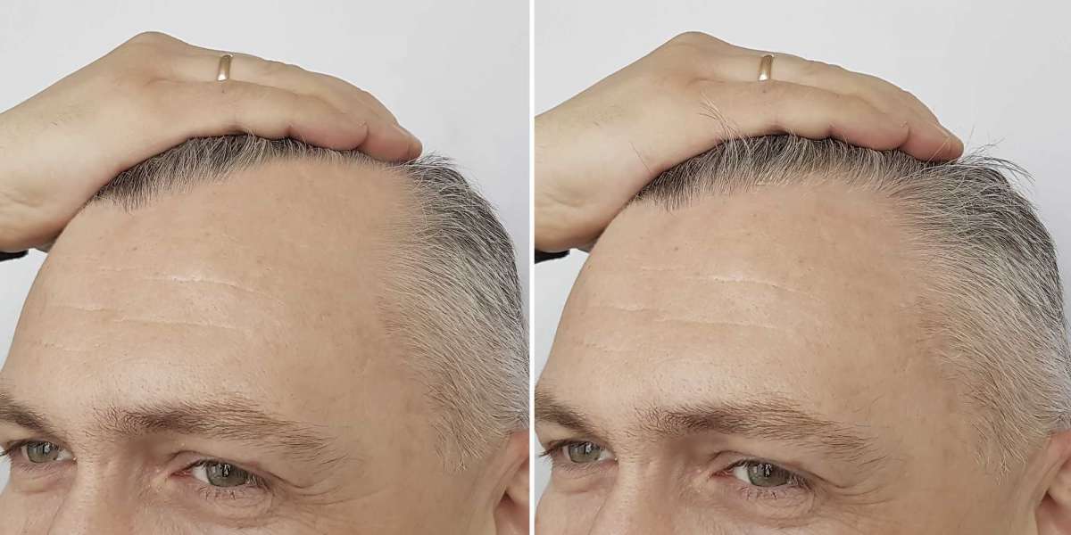 What Are The Benefits Of Having A Hair Transplant Surgery?