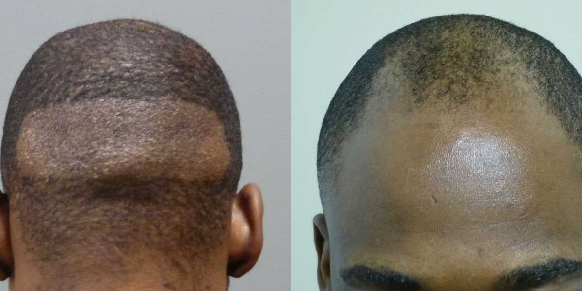 African American Hair Transplant Cost: Procedure And Its Benefits