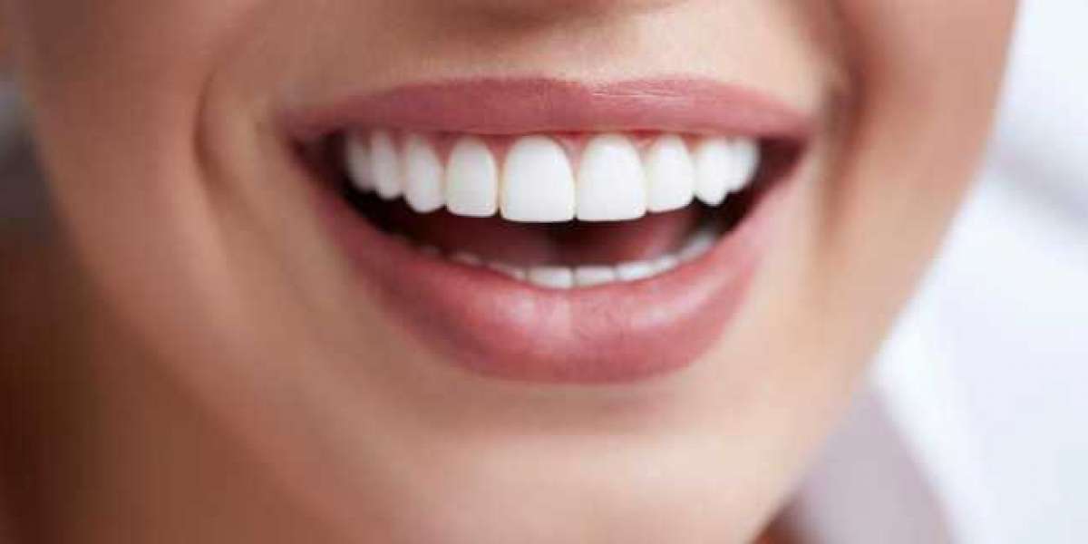 Exactly how Remodeling Veneers can Improve your Smile