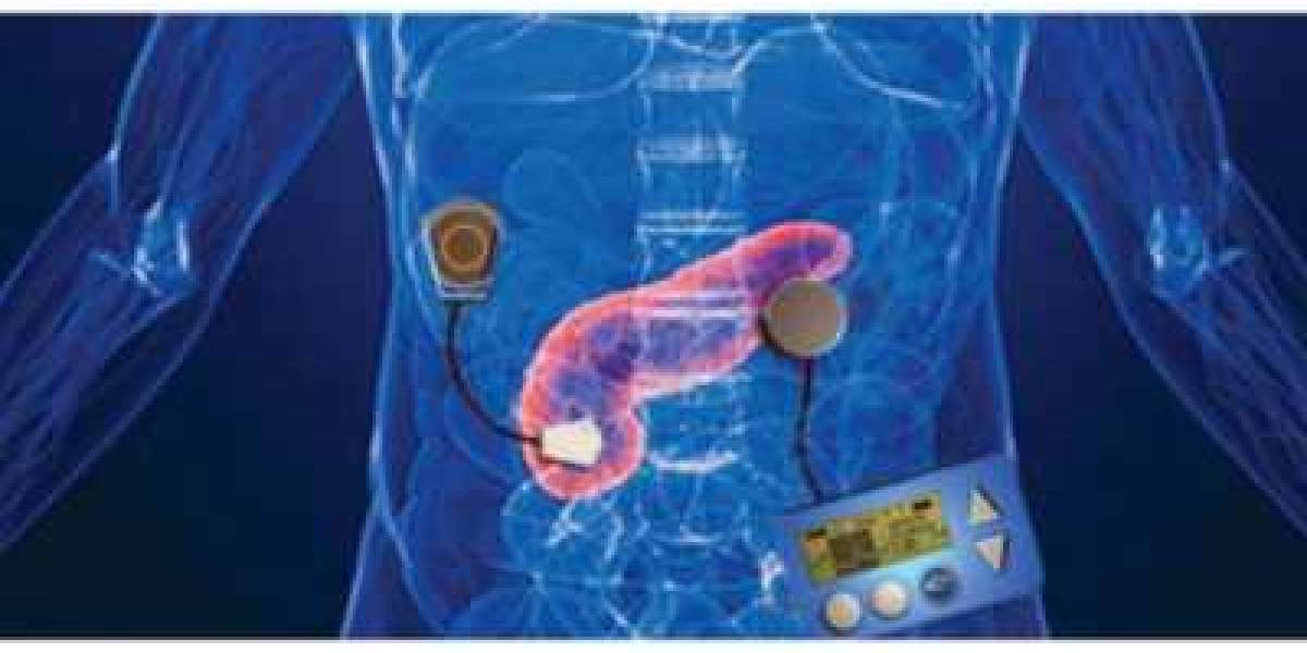 Artificial Pancreas Device System Market: Global Industry Analysis, Size, Share, Growth, Trends, and Forecasts 2023-2030