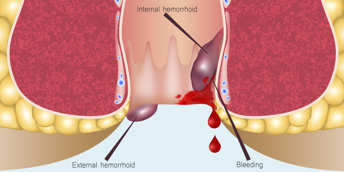 Hemorrhoids Treatment Market Share to Cross USD 725.9 Million Valuation by 2030