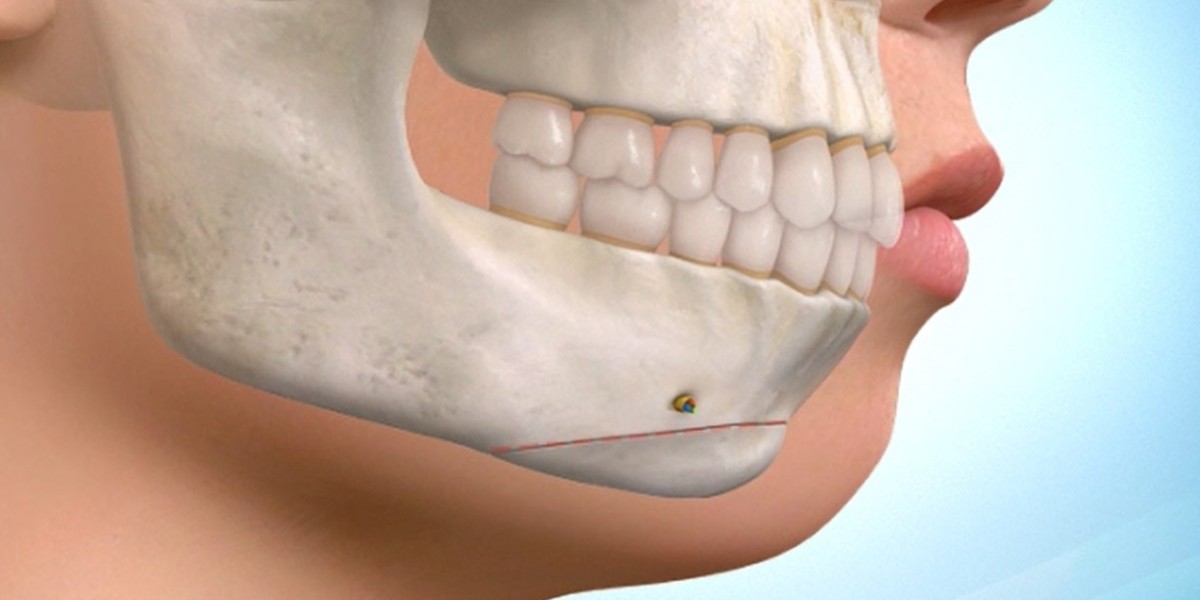 TMJ Implants Market Share Moving Up with a Decent CAGR, Asserts MRFR