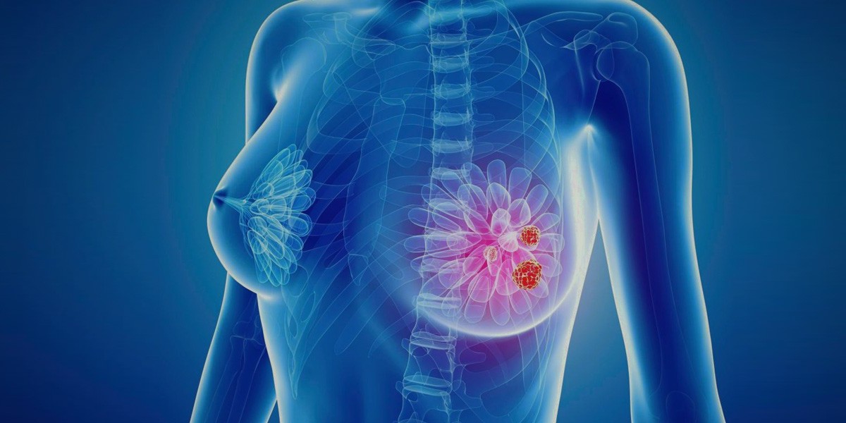 Fibrocystic Breasts Diagnostics and Treatment Market Outlook on Concerns Faced by the Industry