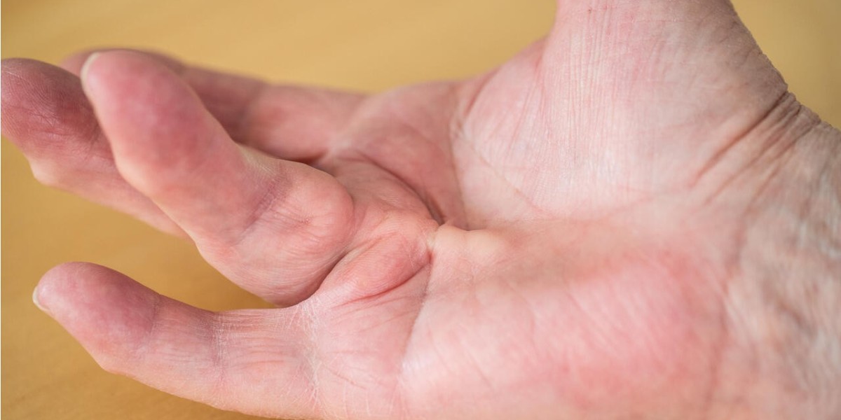Americas to Spearhead Dupuytren’s Contracture Market Share
