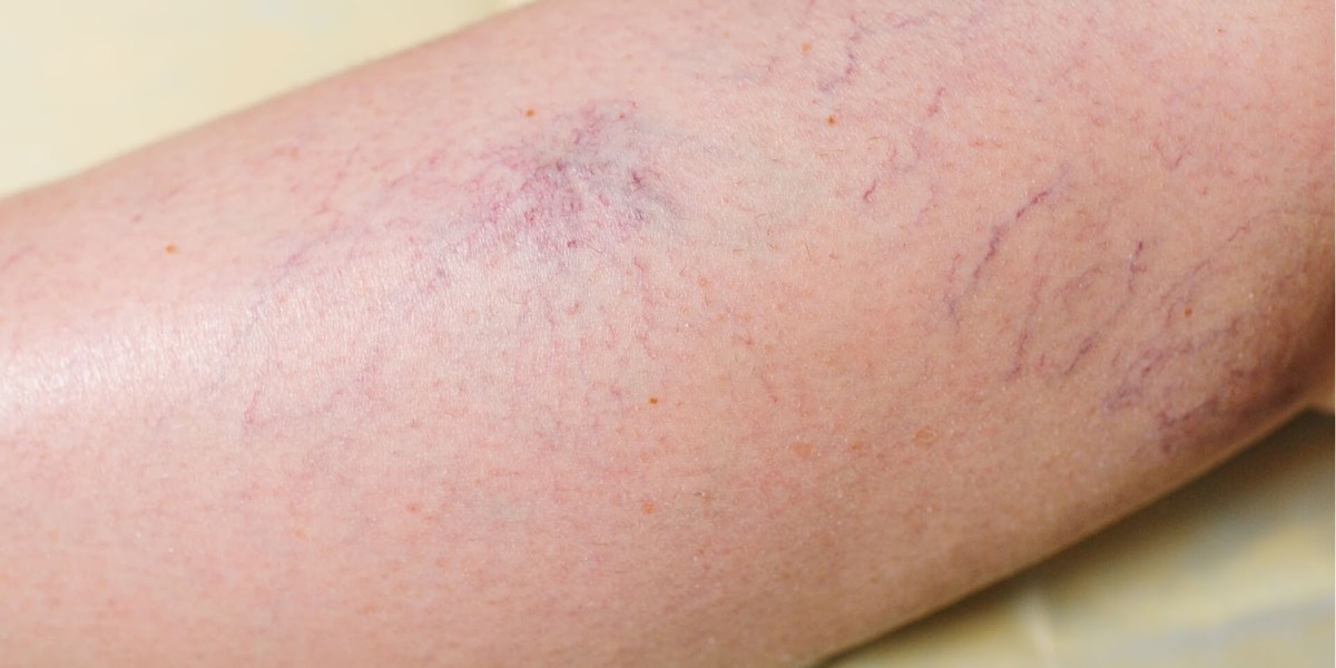 Understanding Spider Veins: Causes, Symptoms, and Treatment