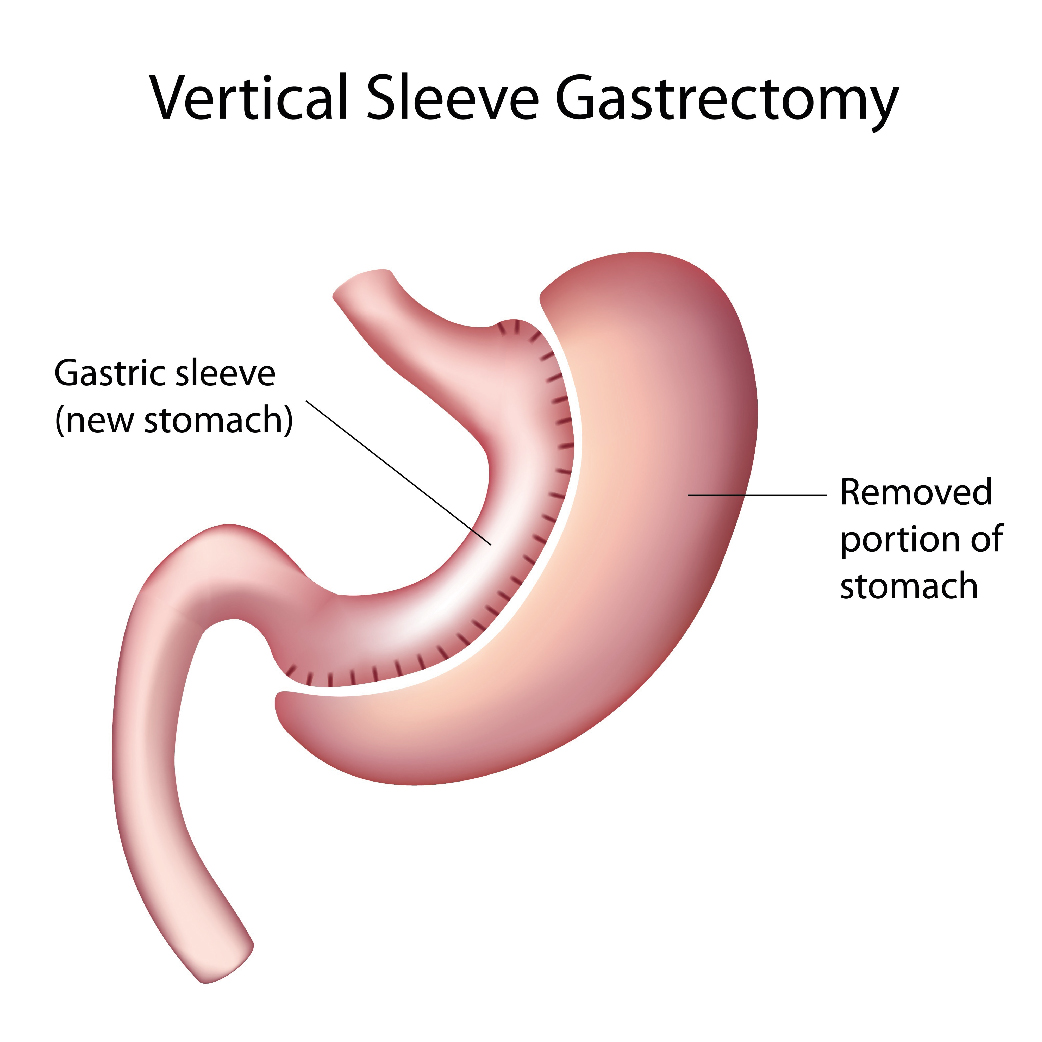 Best Gastric Sleeve Surgery in Turkey All-inclusive