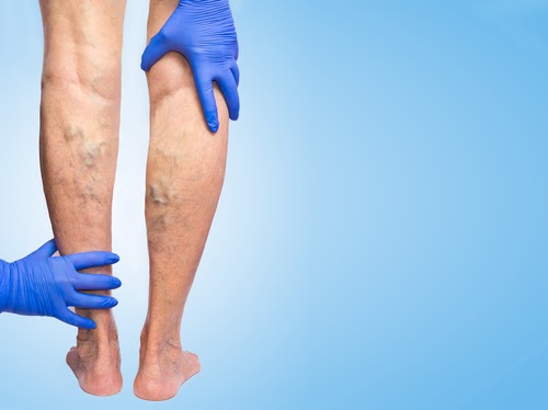 Unveiling the Expertise: Finding the Best Endovascular Surgeon for Varicose Veins in Abu Dhabi