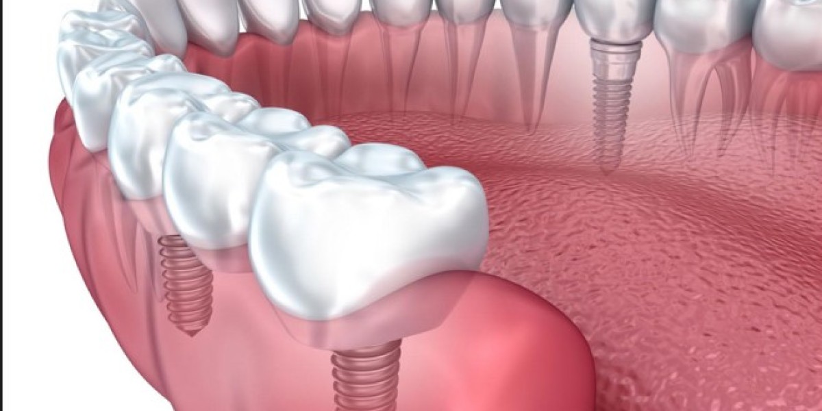 Are All-On-4 Dental Implants Right for You?