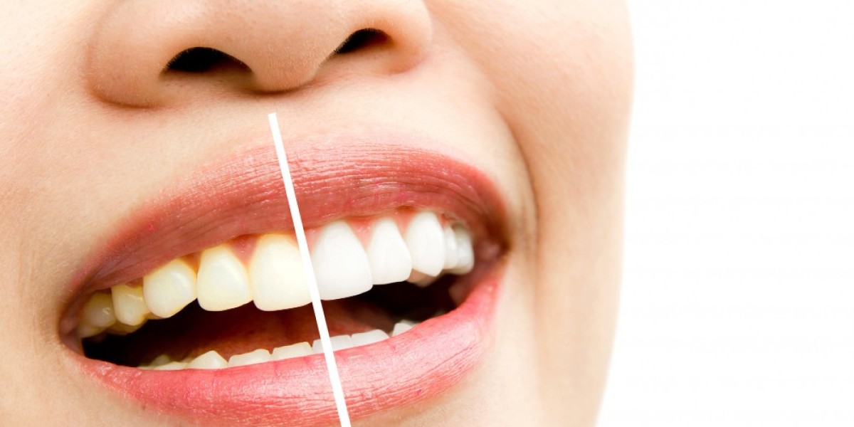Exploring The Interplay Between Nutrition Teeth Whitening And The Gingival Barrier