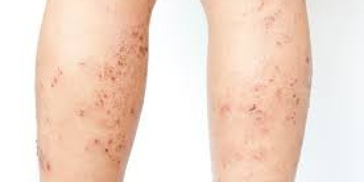 Atopic Dermatitis Treatment Market Size, Share, Trends 2024-2032