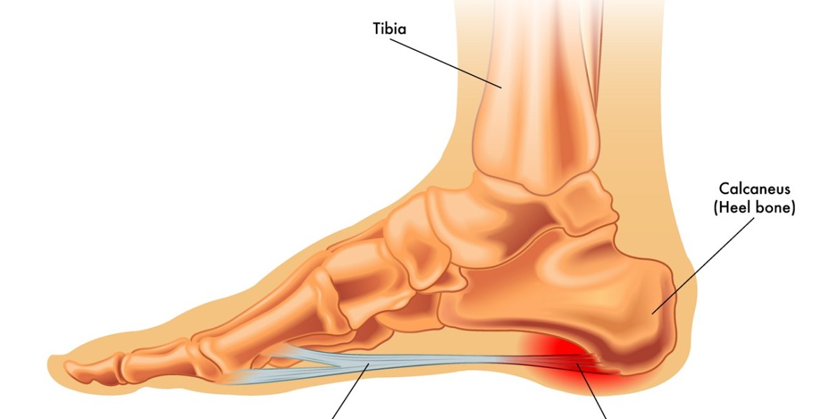 Walking Tall Again: How Innovation is Transforming Plantar Fasciitis Care
