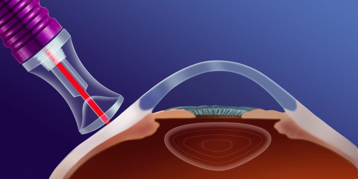 Minimally Invasive Hope: Unveiling the Rise of MIGS for Glaucoma Treatment