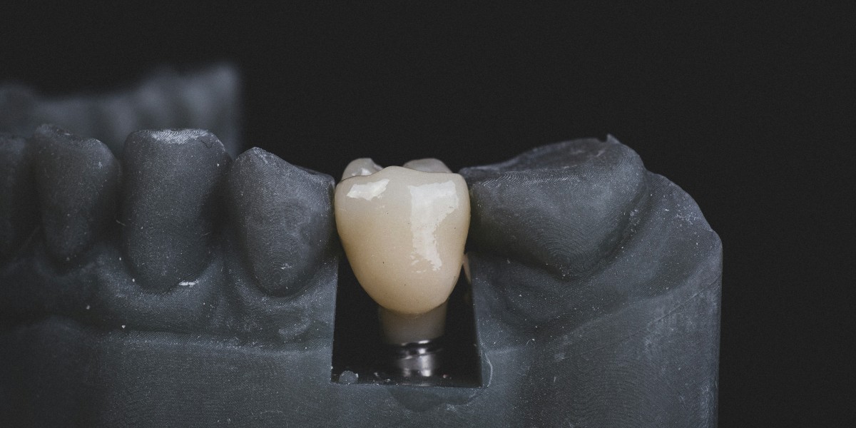 The 10-Step Journey to Perfect Teeth: Your Dental Implant Timeline