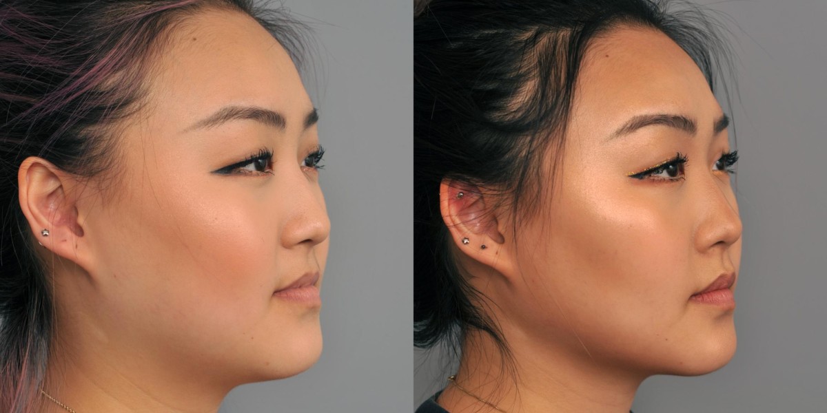 How Can Cheek Reduction Surgery Improve Your Appearance?